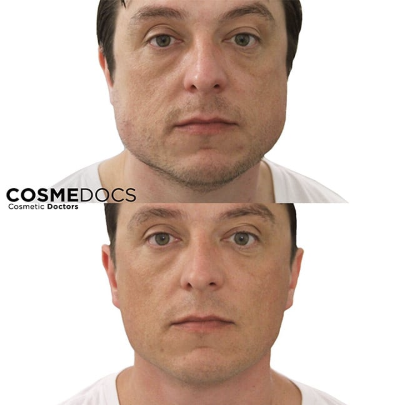 botox treatments for masseter before after