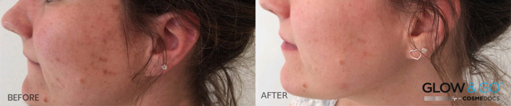 acne-scars-before-after