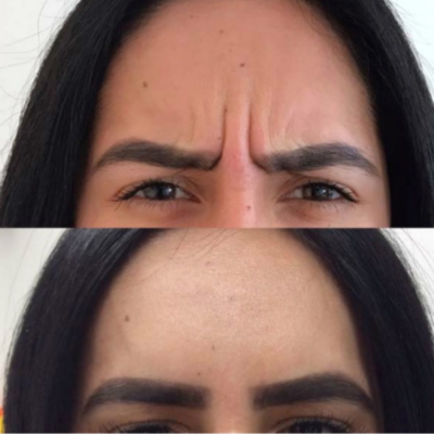 botox frown lines before after