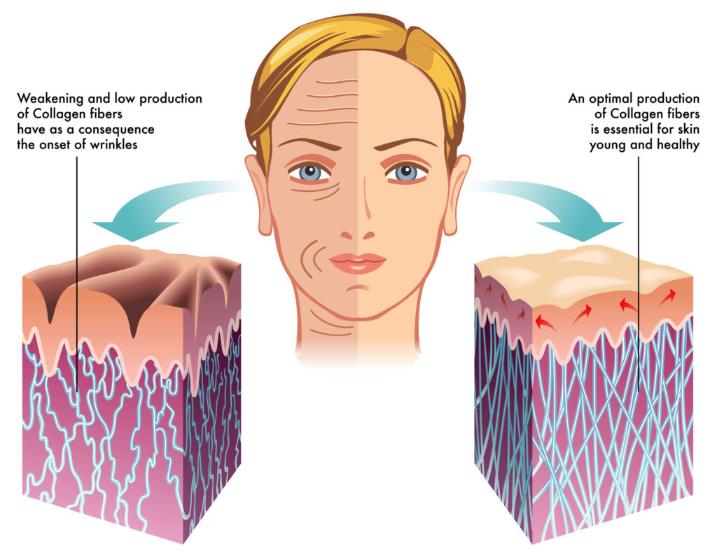 Comparison of skin: low collagen vs. high collagen production