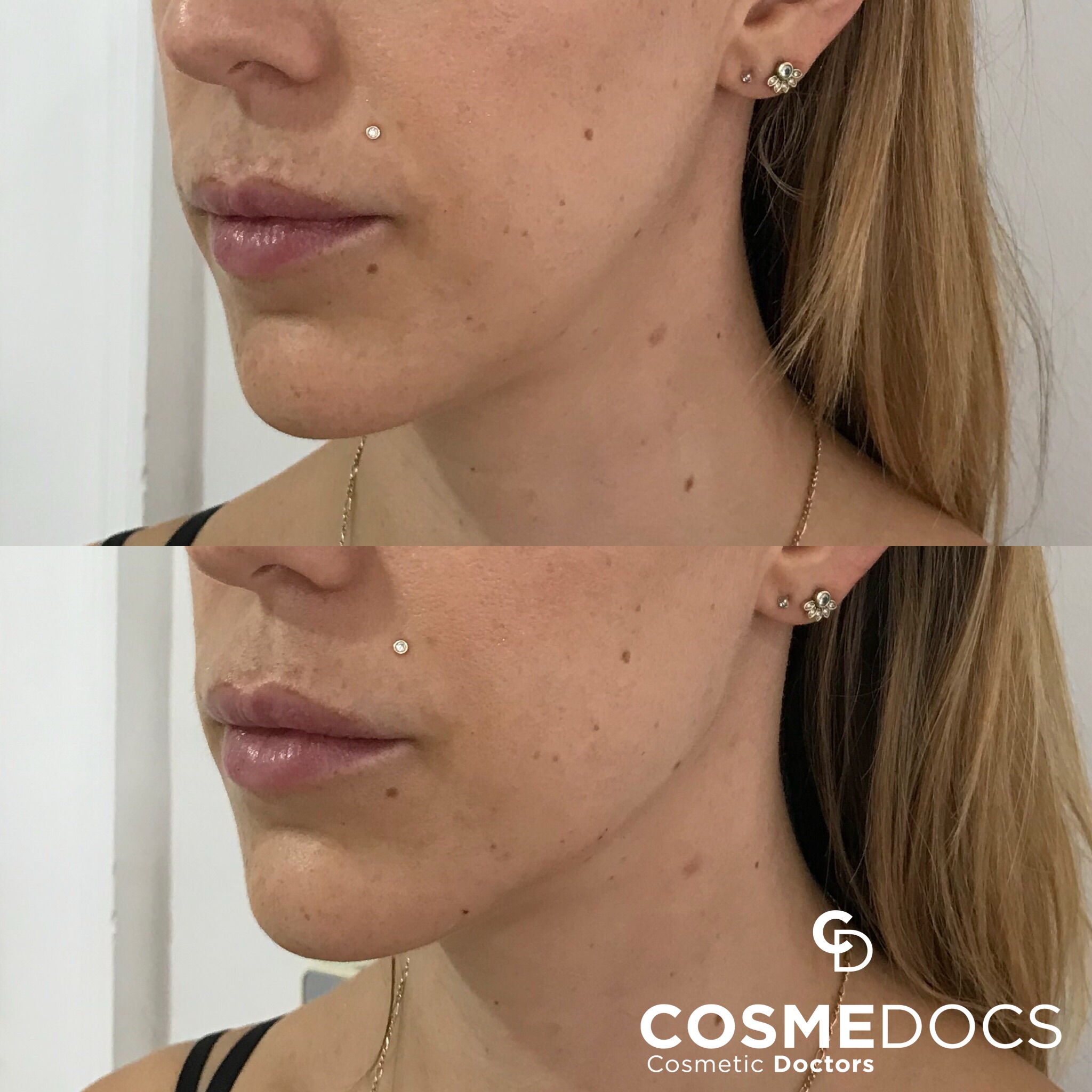 double chin treatment before and after