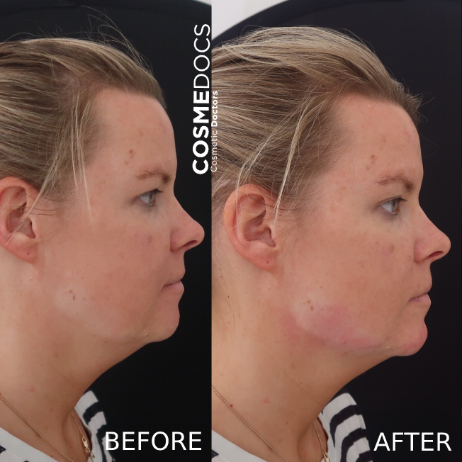jawline before and after treatment