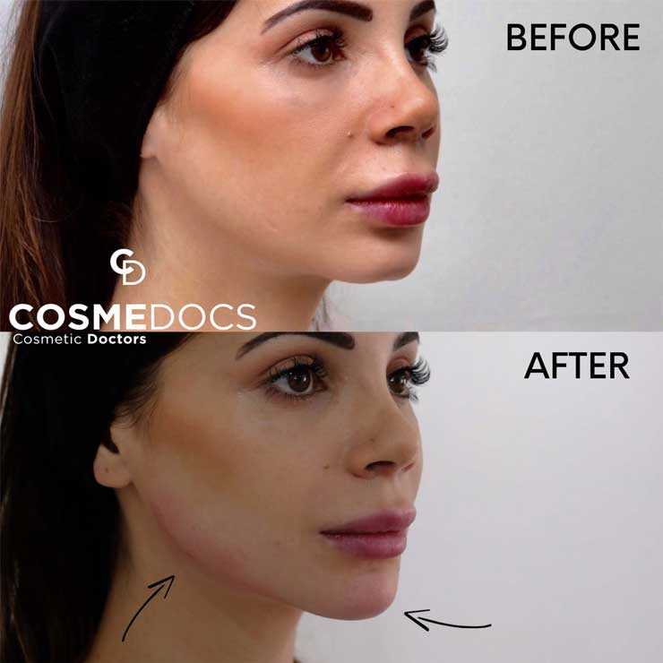 lower face enhancement using dermal fillers