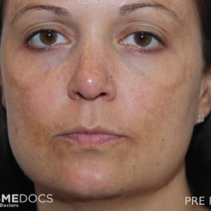 peel-to-reveal first treatment