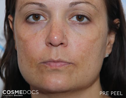 peel-to-reveal first treatment