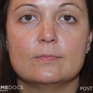 peel-to-reveal second treatment