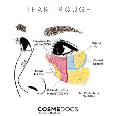 tear trough illustration