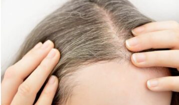 aging causes hair loss