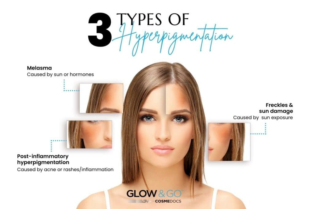 types of hyperpigmentation