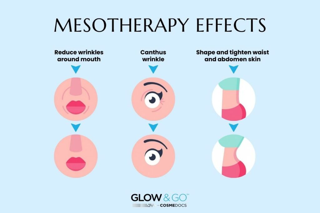 mesotherapy effects