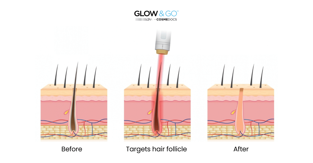 Do you really know the triple wavelength laser hair removal?