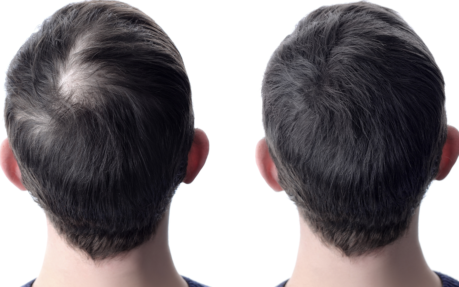 different types of hair transplant