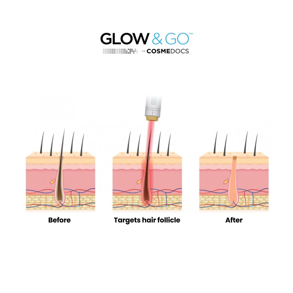 laser hair removal befor and after