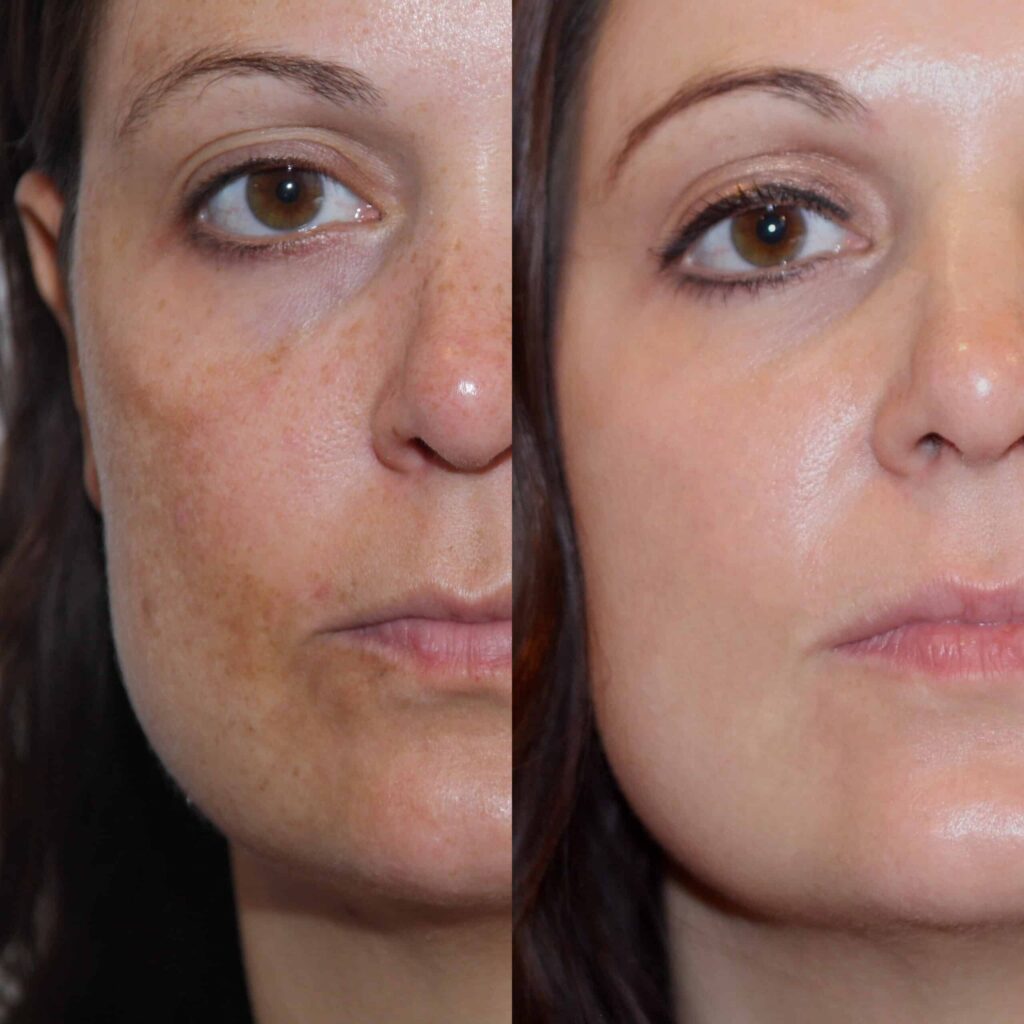 melasma before and after 