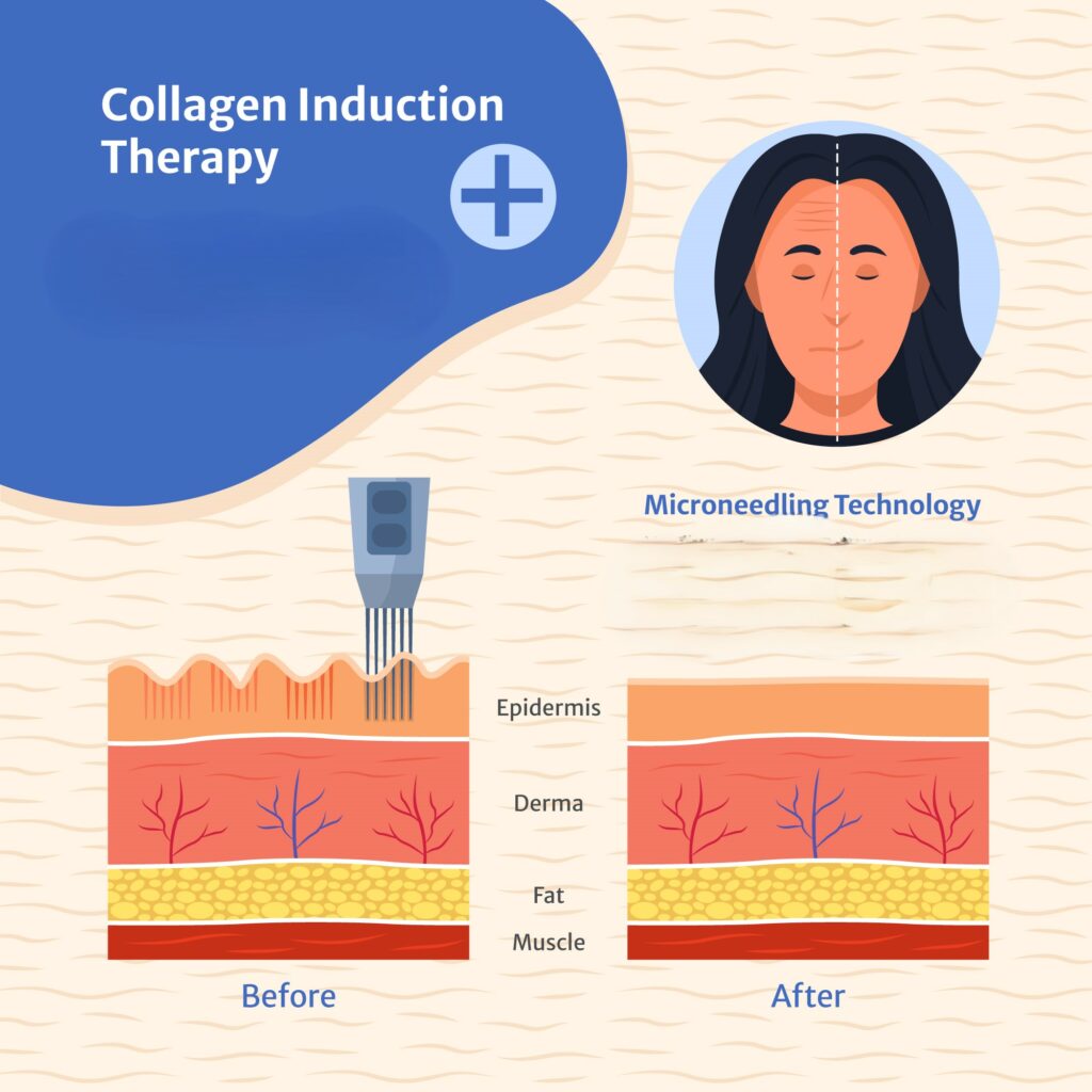Microneedling treatment in Lahore promoting collagen production