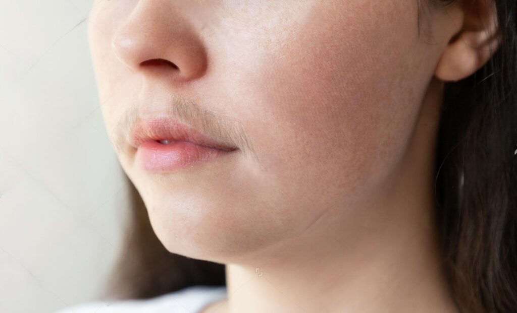 PCOS awareness: girl with excess facial hair especially on upper lips